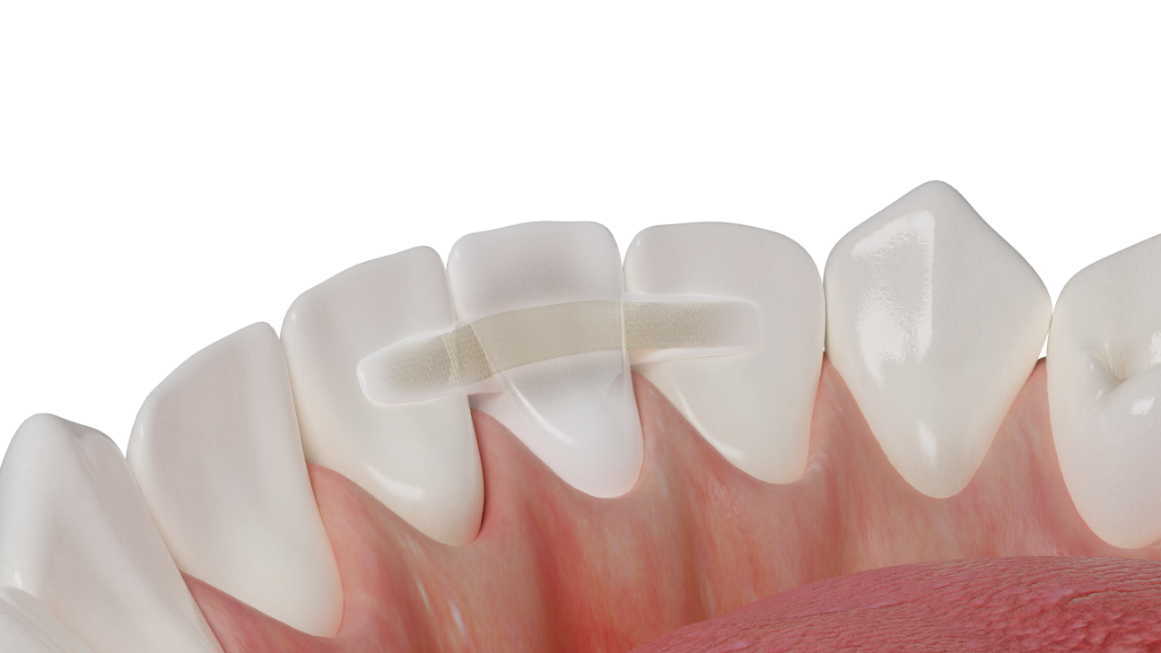 Dentapreg esthetic restoration showing composite for natural-looking teeth