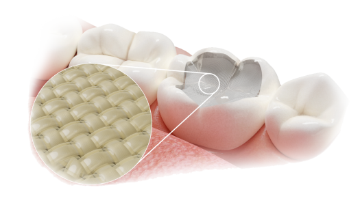 Fibrafill CUBE dental restoration blocks, easy to use, strengthens and protects compromised teeth.