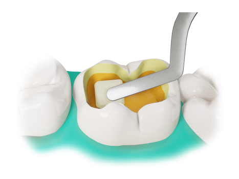 Application of Fibrafill CUBE dental restoration block in tooth cavity, innovative dosage, braided reinforcing lamina.