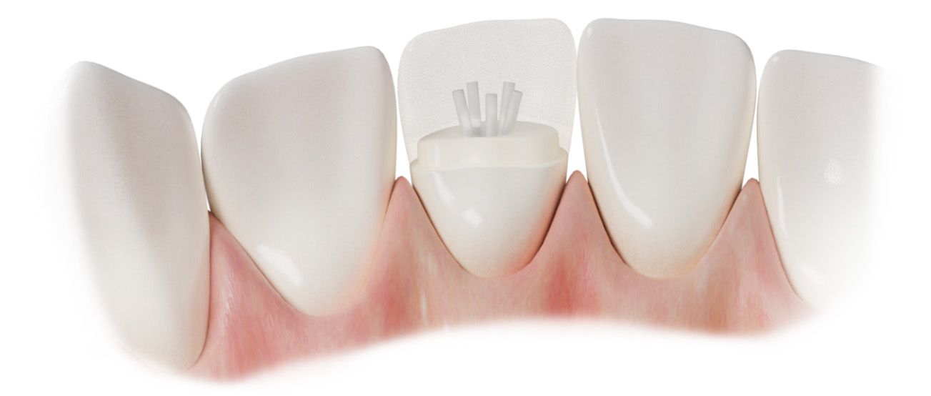 Dentapreg for dental splints, temporary bridges and complex restorations