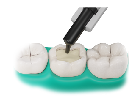 Application of Fibrafill Dentin dental restoration material in tooth cavity, robust and condensable solution.