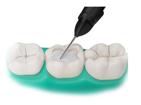 Application of Fibrafill Flow dental composite in tooth cavity, flowable precision with enhanced toughness.