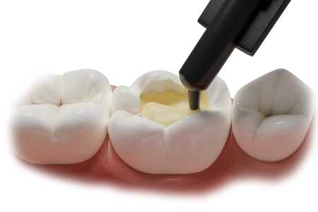 Application of Fibrafill Flow composite in tooth cavity for seamless restoration.