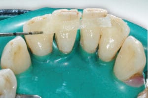 Application of Dentapreg® SFM strip on anterior teeth for extracoronal splinting.