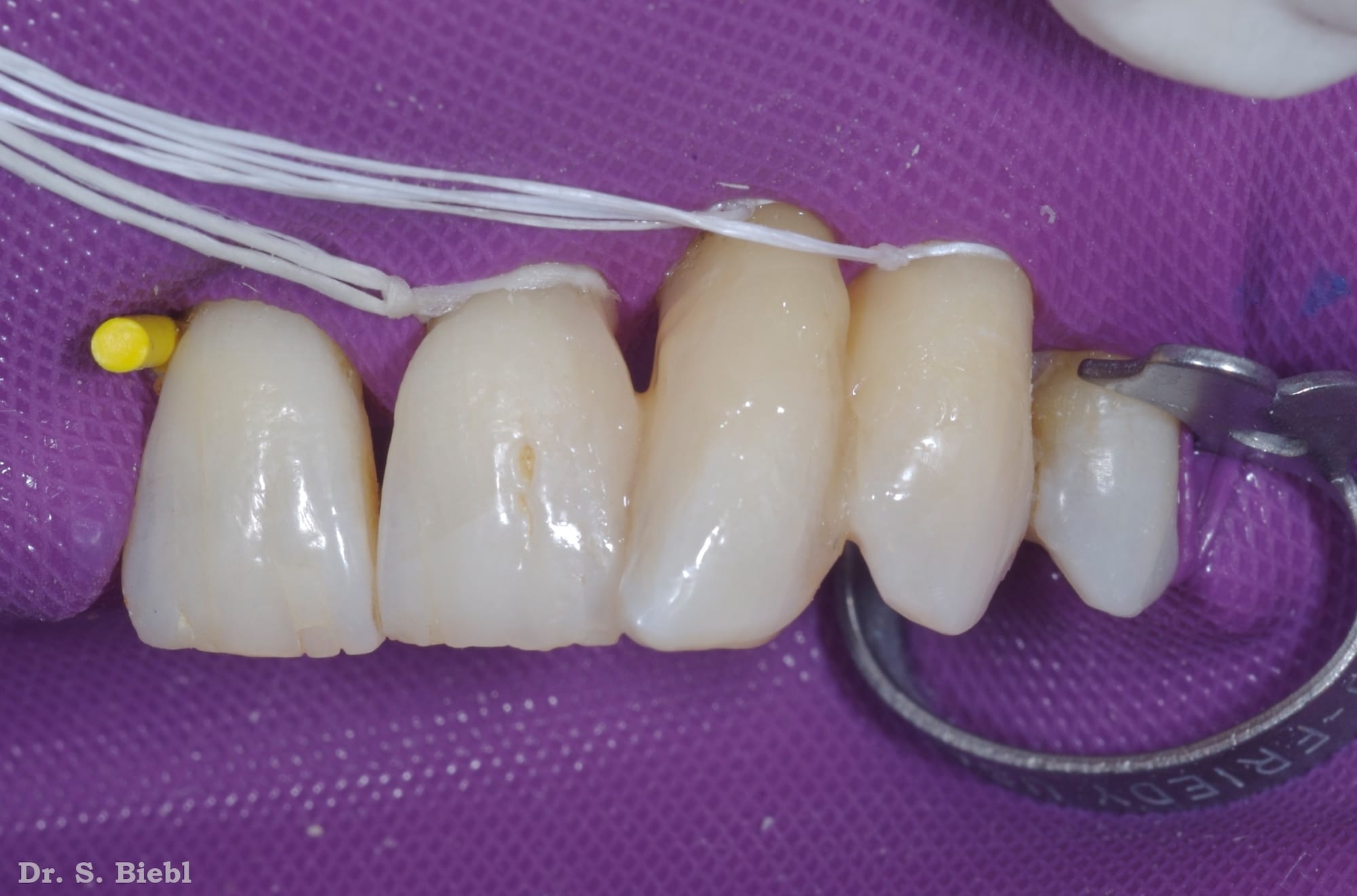 Final stabilization of Dentapreg® SFM splint by Dr. Biebel, providing robust support.