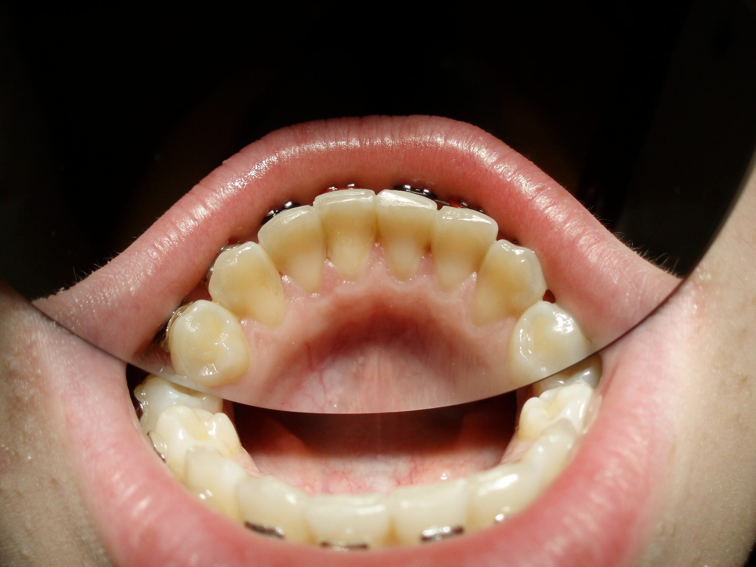 Second step: Dr. Fillipi ensures alignment with Dentapreg® SFM strip on lower teeth.