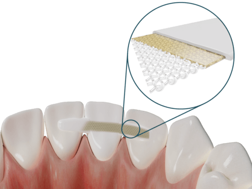 Ponte anteriore con Dentapreg® PFM