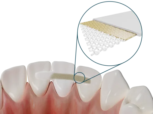 Dentapreg® PFM Anterior Bridge