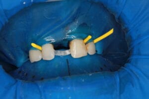 Dentapreg® PFM strip applied to anterior teeth with rubber dam isolation for stability.