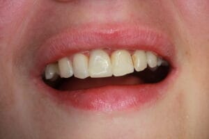 Completed dental restoration with Dentapreg® PFM strip on anterior teeth.