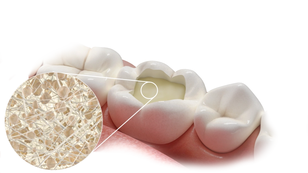 Dettaglio della struttura di Fibrafill® e la sua integrazione nell'otturazione del restauro dentale.