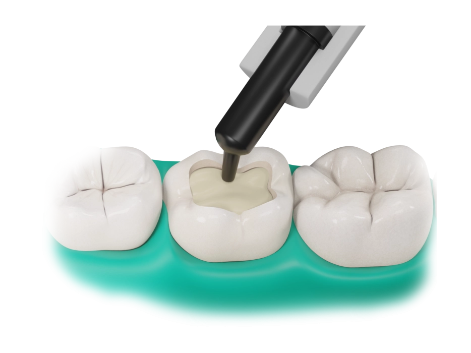 Applicazione dello strato di Fibrafill® Dentin nella cavità dentale preparata per la ricostruzione.