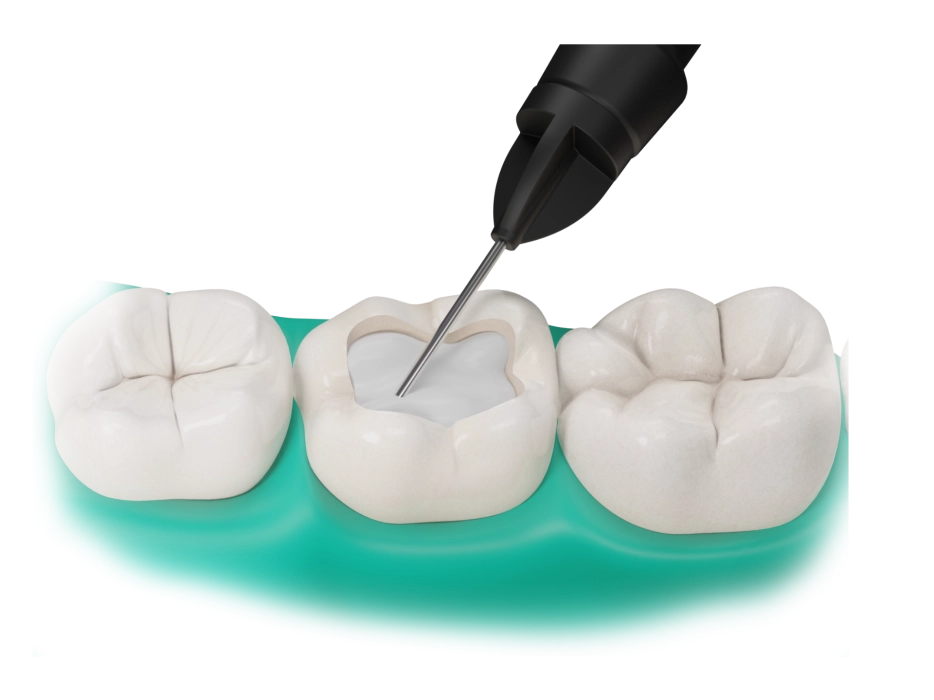 Applicazione dello strato di Fibrafill® FLOW nella cavità dentale preparata per il restauro.