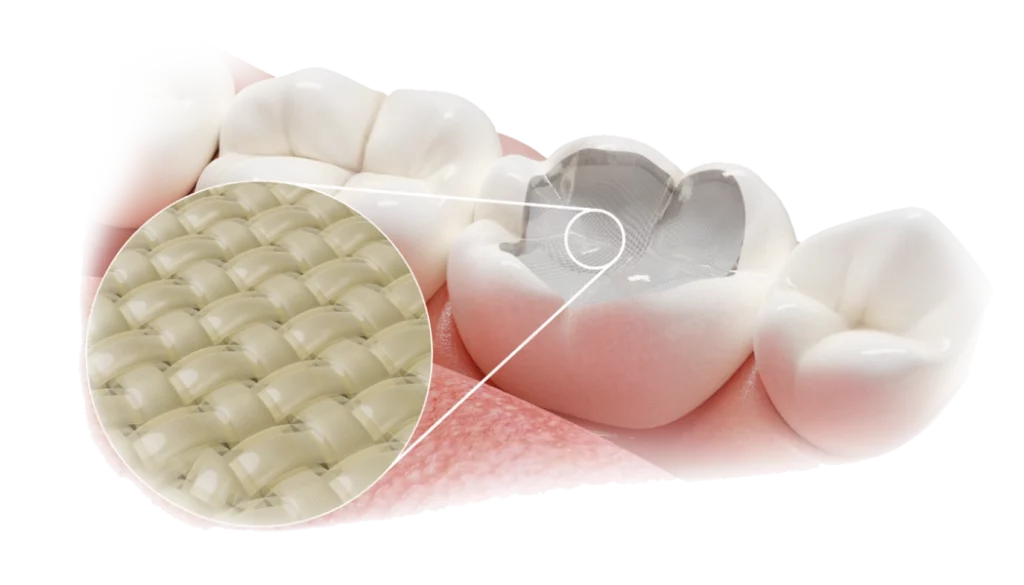 Dettaglio della struttura intrecciata di Fibrafill utilizzata nella cavità dentale per migliore sostegno.