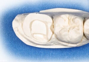 Stone model showing prepared cavity for reinforcement with Dentapreg® VEIL.