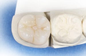 Finished composite crown reinforced with Dentapreg® VEIL on the stone model.