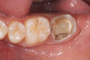 Tooth prepared for onlay restoration with Dentapreg® VEIL, ensuring durable dental reinforcement.