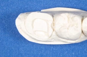 Dental model showing precise onlay preparation with Dentapreg® VEIL for enhanced tooth stability.