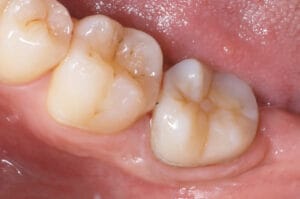 Completed onlay restoration using Dentapreg® VEIL, providing strong and natural-looking dental reinforcement.