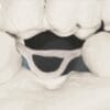 Ponte posteriore Dentapreg® BUNDLE Lab