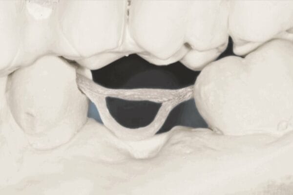 Ponte posteriore Dentapreg® BUNDLE Lab