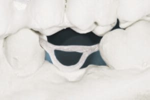 Dentapreg® BUNDLE forming framework for dental bridge on model.