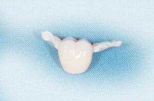 Dentapreg® BUNDLE reinforcing highly aesthetic composite dental bridge.