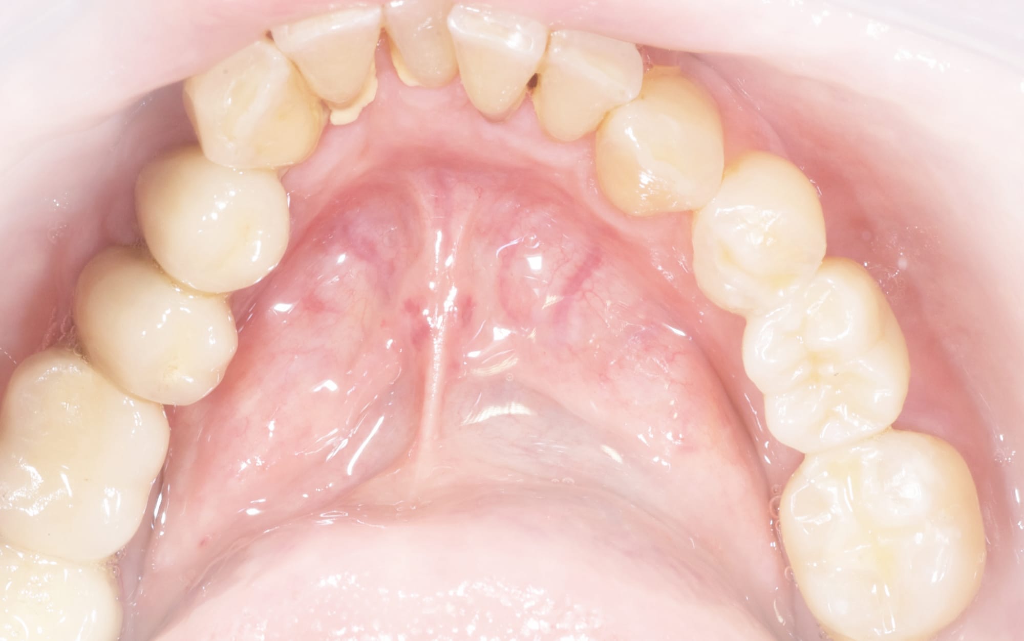 Dentapreg® BUNDLE dental bridge in situ within patient’s mouth.