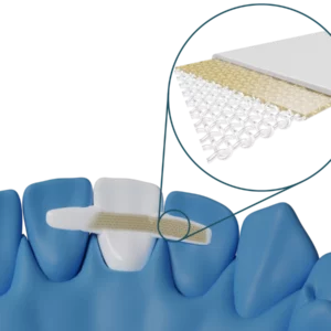 Ponte anteriore Dentapreg® BRAID per il laboratorio