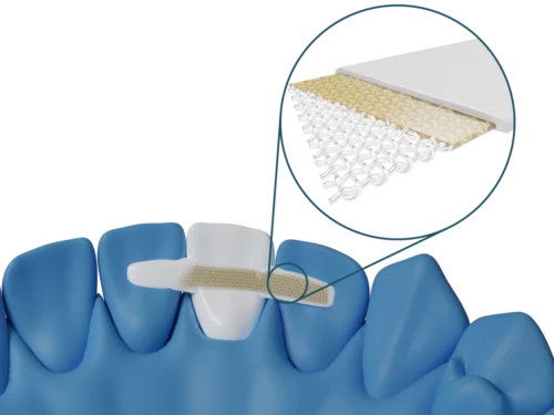 Ponte anteriore Dentapreg® BRAID per il laboratorio