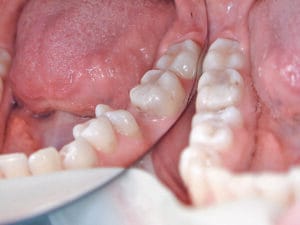 Dentapreg® BUNDLE Case