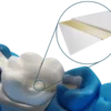 Ponte posteriore Dentapreg® BUNDLE Lab