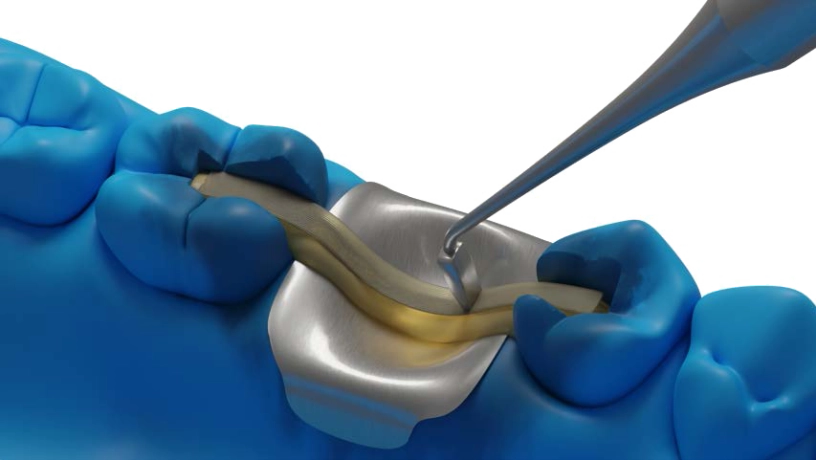 Dentapreg® BUNDLE applicato per la stabilizzazione di denti posteriori sul modello dentale.