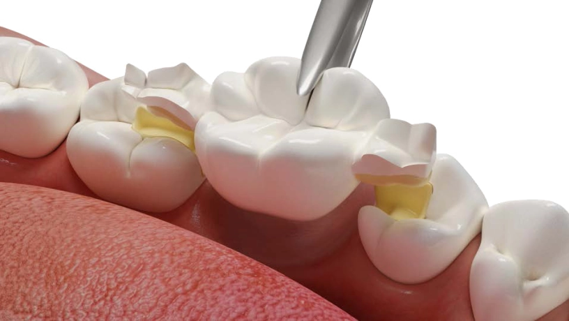 Dentapreg® BUNDLE adattato ai denti posteriori per il rinforzo.