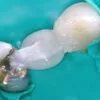 Dentapreg® PFU Posterior Bridge Case