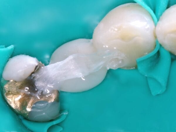 Dentapreg® PFU Posterior Bridge Case