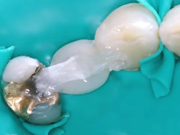 Dentapreg® PFU Posterior Bridge Case