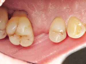 Close-up view of teeth before applying Dentapreg PFU for stabilization and reinforcement.