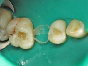 Application of Dentapreg PFU® strip for dental stabilization with rubber dam isolation.