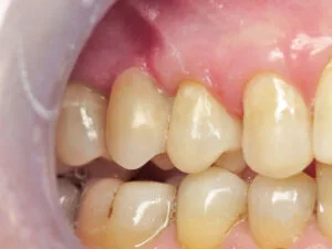 Final restoration with Dentapreg PFU® for reinforced dental stabilization and aesthetic finish.