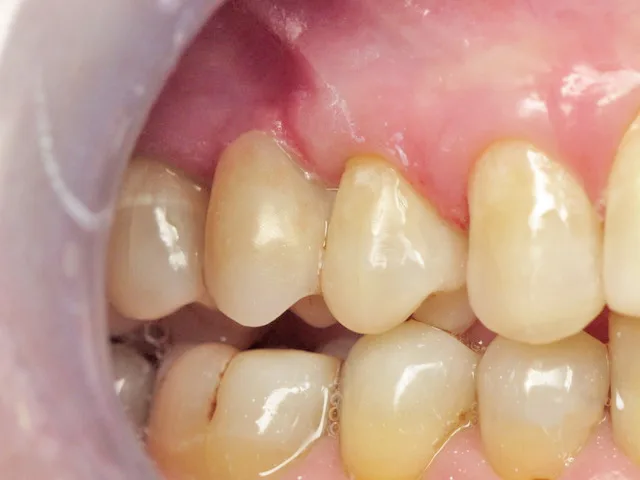 Final restoration with Dentapreg PFU® for reinforced dental stabilization and aesthetic finish.