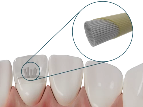 Rinforzo per protesi Dentapreg® MESH
