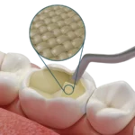 Dosi di riempimento bulk-fill con membrana Fibrafill® CUBE