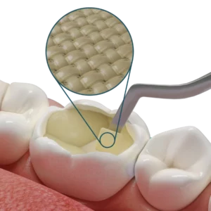 Dosi di riempimento bulk-fill con membrana Fibrafill® CUBE