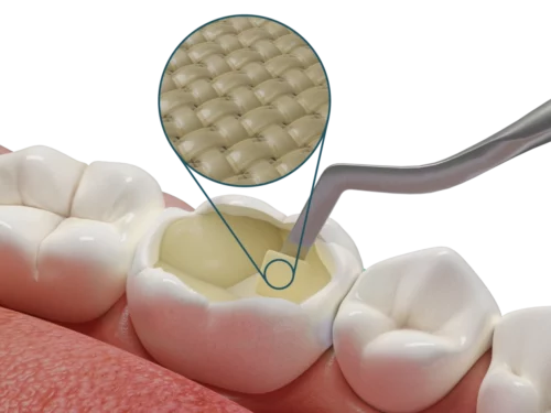 Dosi di riempimento bulk-fill con membrana Fibrafill® CUBE