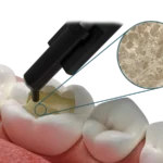 Fibrafill® DENTIN Materiale bulk-fill con fibre corti