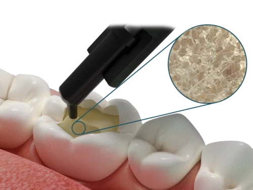 Fibrafill® DENTIN Materiale bulk-fill con fibre corti