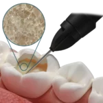 Fibrafill® FLOW Composito fluido con fibre corti