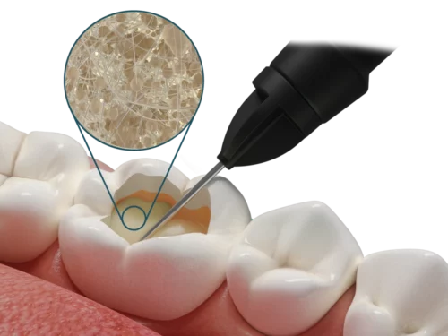 Fibrafill® FLOW Composito fluido con fibre corti