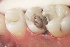 Dentapreg® PINPost fiber post placed inside a prepared tooth canal.